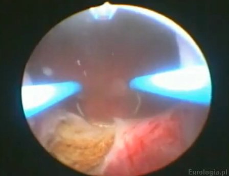TURP - przezcewkowa resekcja gruczołu krokowego
