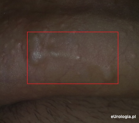 Twarda zmiana pod sk&oacute;rą penisa