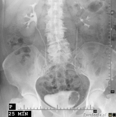 Urografia - ubytek wypełnienia - guz pęcherza moczowego