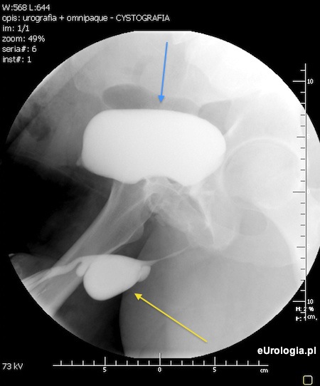 Uchyłek cewki moczowej - uretrografia
