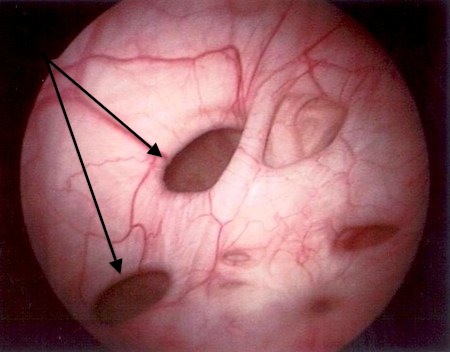 Drobne uchyłki pęcherza moczowego