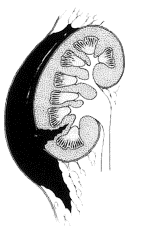 Uraz nerki IIIstopień
