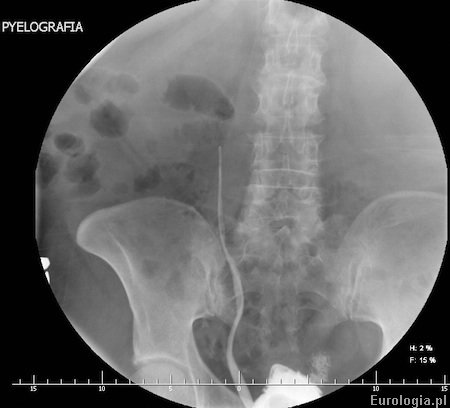 Ureteropielografia wstępująca