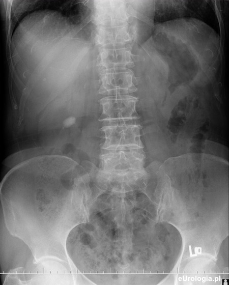 Urografia - kamica nerki prawej
