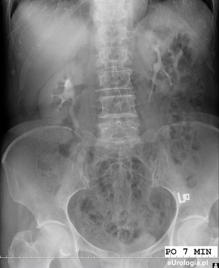 Urografia - zł&oacute;g 20x10 milimetr&oacute;w nerki prawej