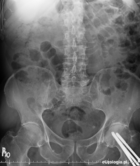 Urografia - kamień w dolnym odcinku lewego moczowodu