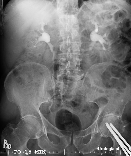 Urografia - kamień w dolnym odcinku lewego moczowodu