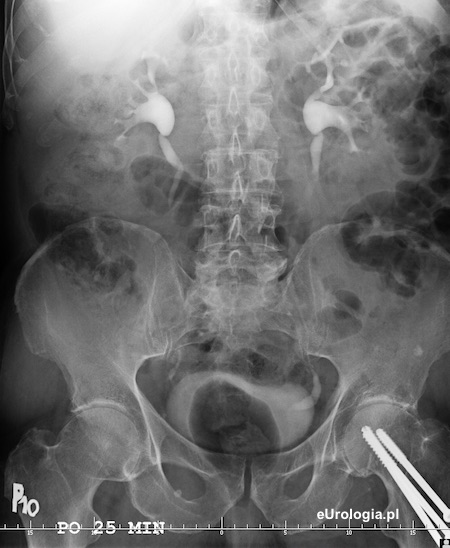 Urografia - kamień w dolnym odcinku lewego moczowodu