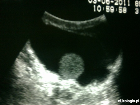 Wodniak jądra po urazie - USG