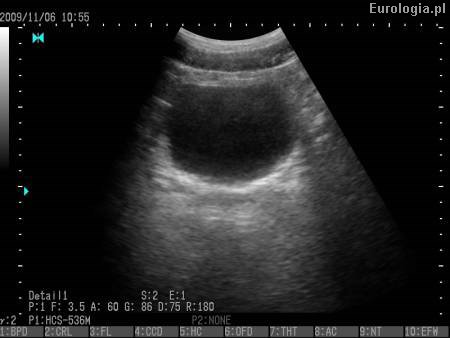 Obraz USG pęcherza moczowego - zaleganie po mikcji