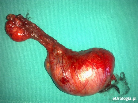 Wynik histologiczny po usunięciu jądra