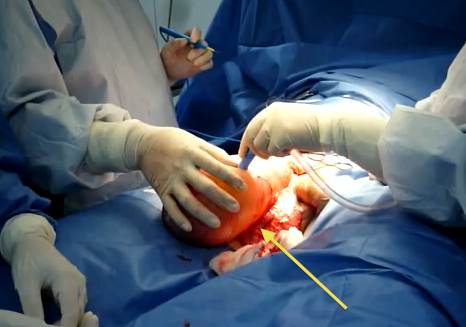 Wodniak jądra - operacja