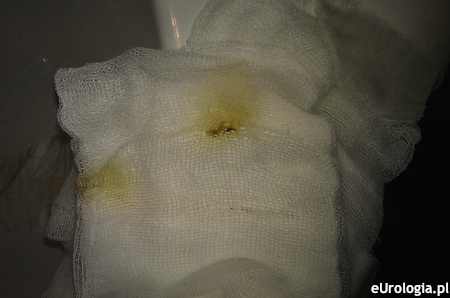 Wodniak jądra - ropa z miejsca po drenie