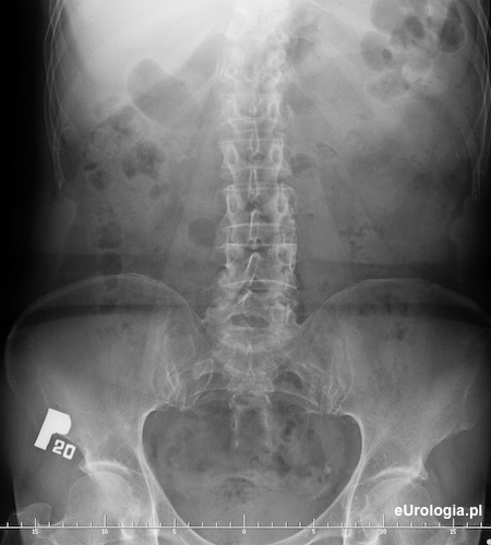 Wodonercze lewostronne - kamica moczowodu - urografia