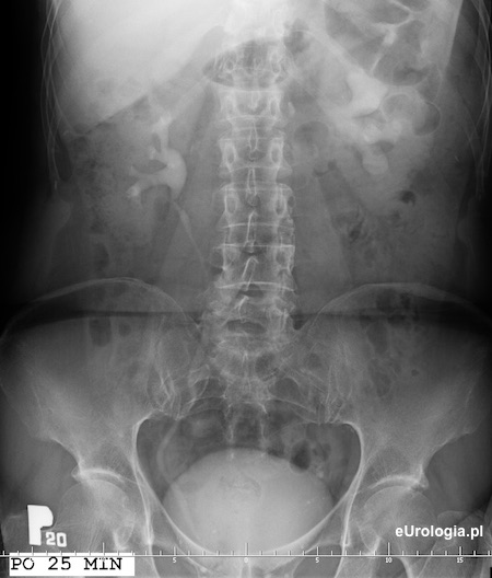 Kamica moczowodu - wodonercze