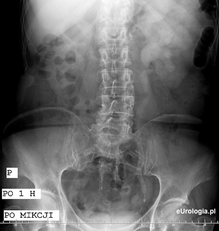 Wodonercze - UROGRAFIA
