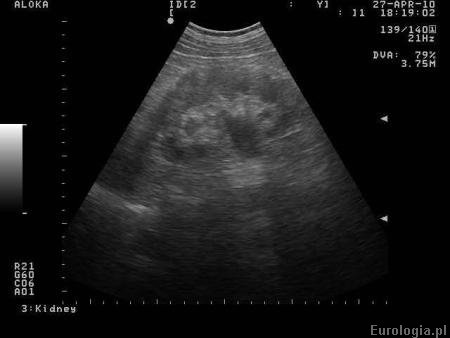 Wodonercze u pacjentki w 28 tygodniu ciąży