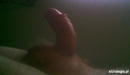 Wykrzywiony penis