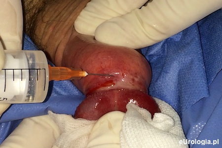 Znieczulenie nasiękowe 1% roztworem lignocainy