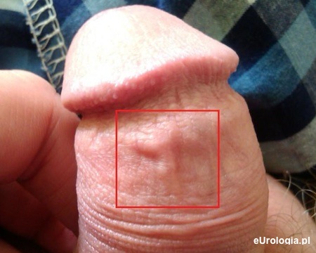 Zgrubienie na napletku