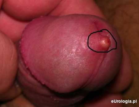 Grudka na wędzidełku prącia