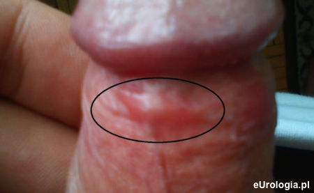 Obrzęk żyły na penisie