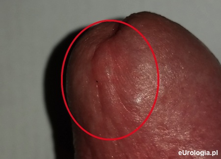 Zgrubienie na żołędzi - obrzęk w okolicy ujścia cewki