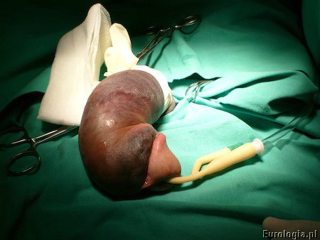Złamanie prącia - zaburzenia erekcji po urazie