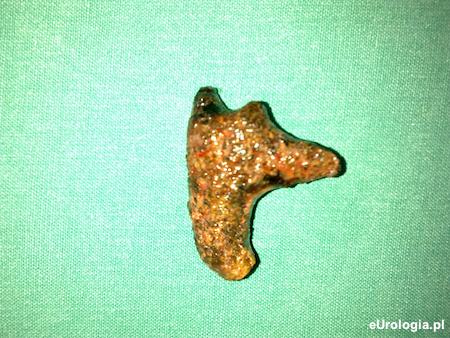 Kamica odlewowa - zł&oacute;g usunięty z nerki