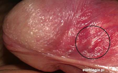 Zmiana na penisie - bolesna agrudka