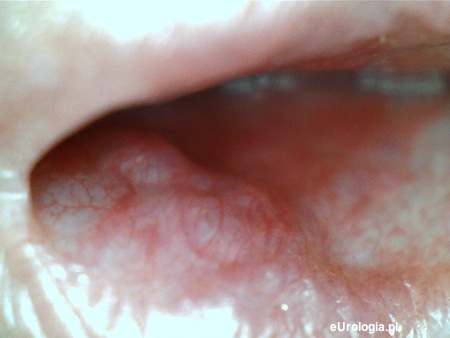 Zmiana w cewce moczowej