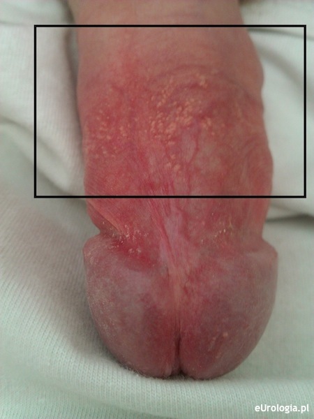 Zmiany na sk&oacute;rze prącia