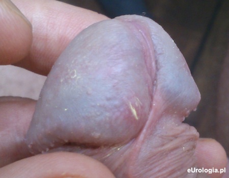 Grudki - dziwne zmiany na żołędziu