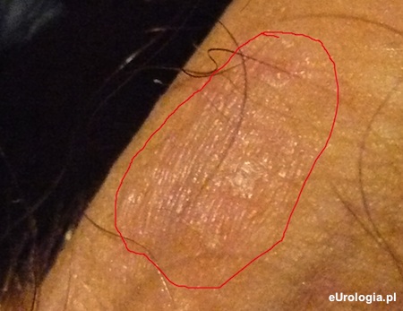 Zmiany sk&oacute;rne penisa