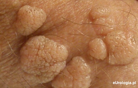 Zmiany skórne w przebiegu infekcji HPV