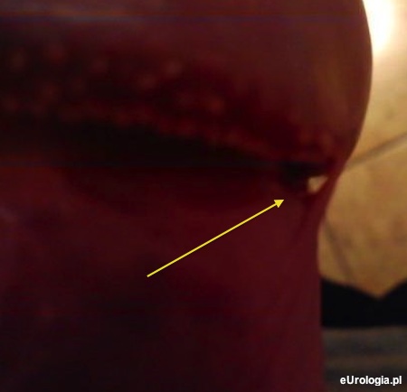 Zrost sk&oacute;ry prącia z koroną żołędzi