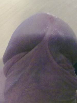 Zrośnięty napletek