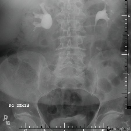 Zwężenie połączenia miedniczkowo - moczowodowego