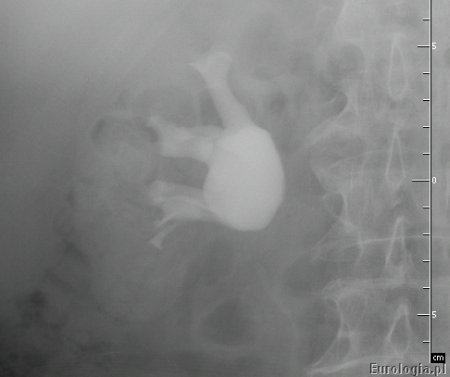 Zwężenie połączenia miedniczkowo - moczowodowego - obraz miedniczki
